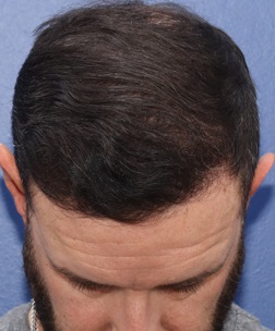 Hair Transplant After 12-18 Months