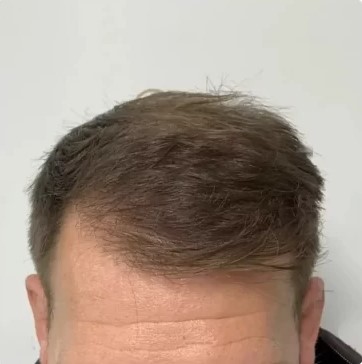 Hair Transplant After 9-12 Months