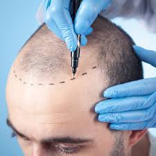 Do Hair Transplants Work? Effectiveness and Success Rates