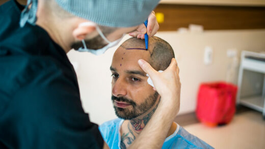 Are You Planning to Have a Real Hair Transplant?