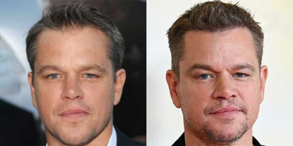 Os segredos por trás do transplante capilar de Matt Damon