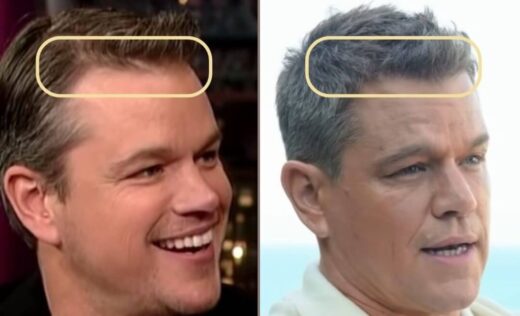 Did Matt Damon Get a Hair Transplant?