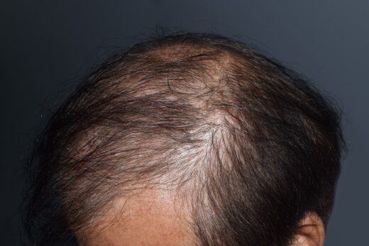 At What Age Do People Typically Start Losing Hair?