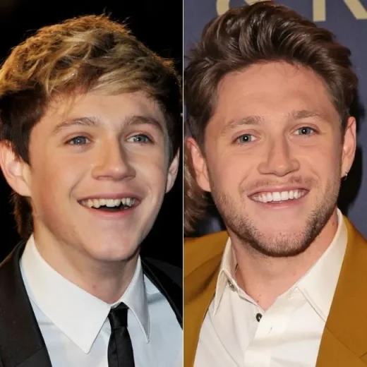 nial-horans-teeth-veneers