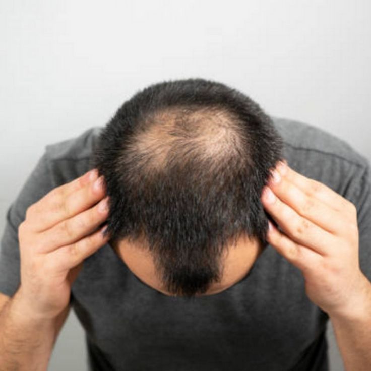 The Norwood Scale, Class 1–7: Understanding Male Pattern Hair Loss