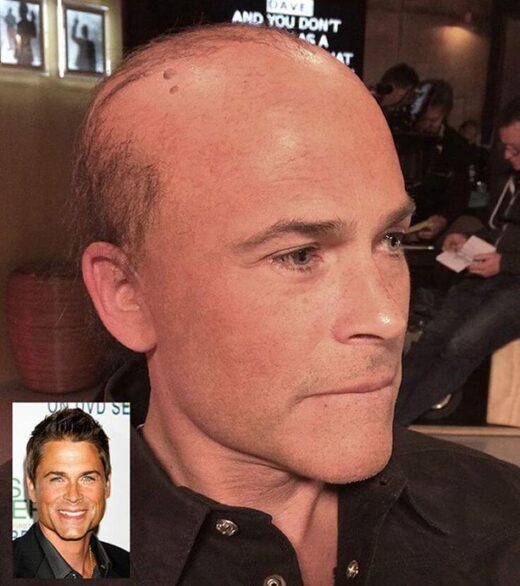 Rob Lowe Hair Transplant & Hair Loss 1 Rob Lowe with the bald cap