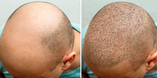 sides-effects-hair-transplant