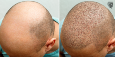 sides-effects-hair-transplant