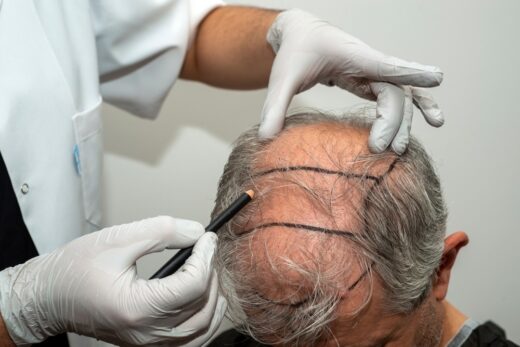 types-of-hair-transplant