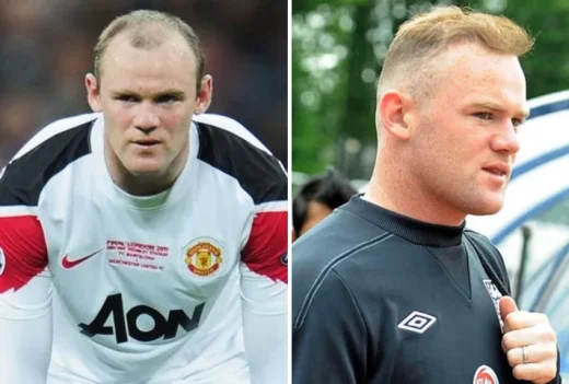 Wayne Rooney's Decision to Get a Hair Transplant