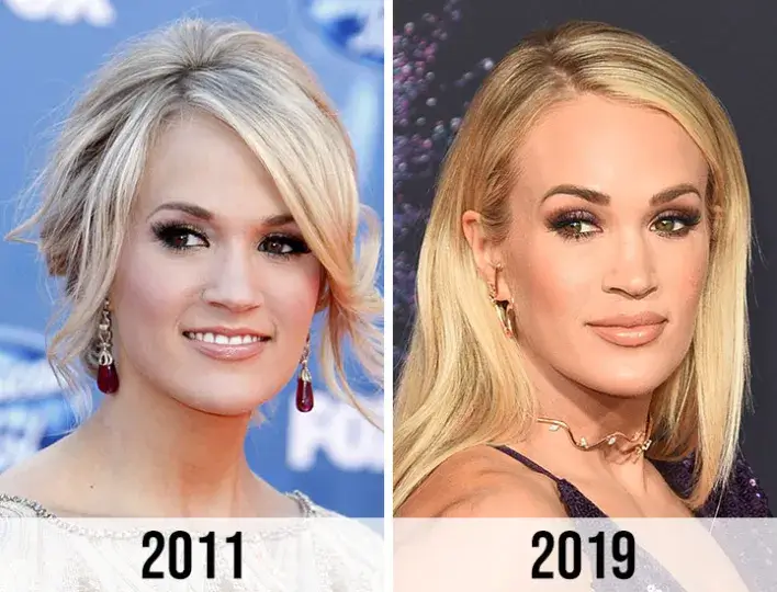 Carrie Underwood and Plastic Surgery: Analyzing Her Transformation