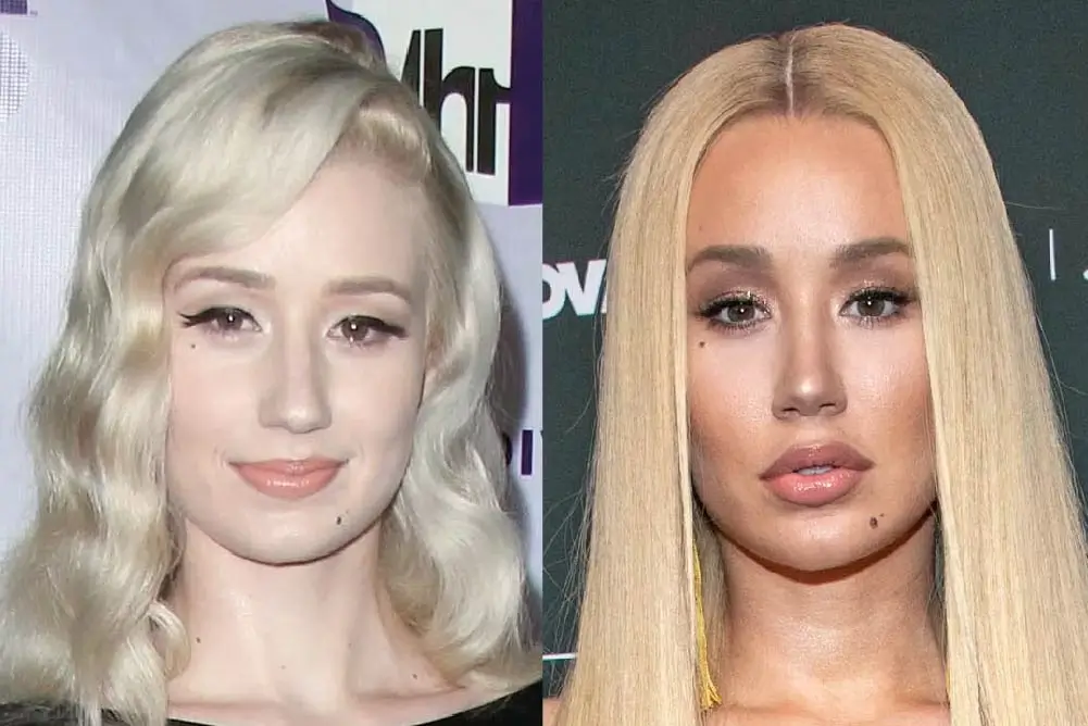 Iggy Azalea’s Plastic Surgery: What Procedures Has She Had?