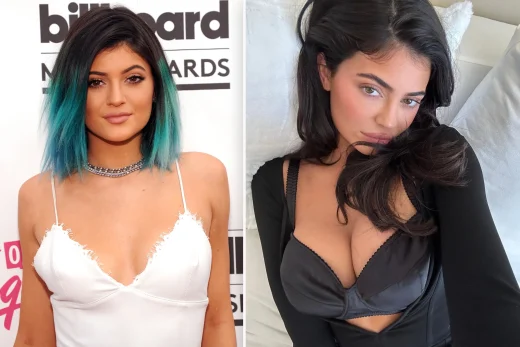 kylie-jenner-breast-augmentation