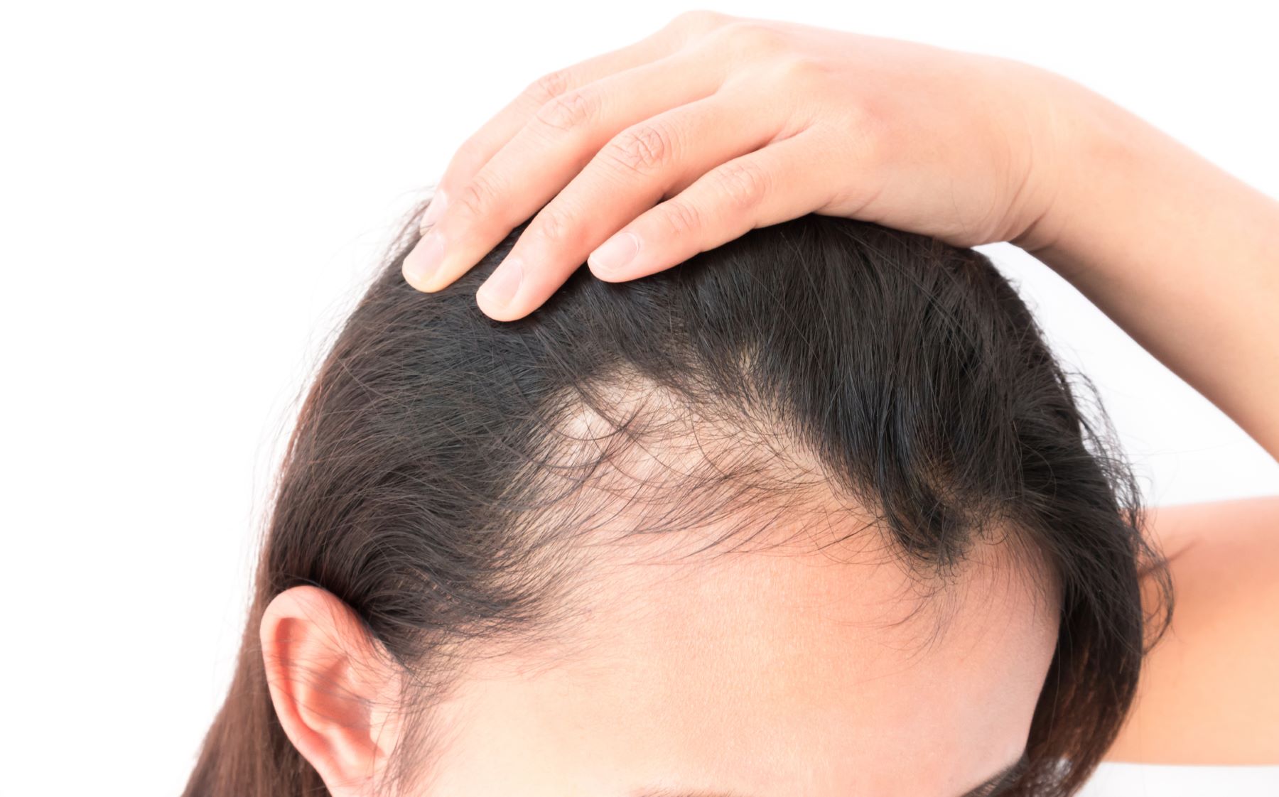 Can Women Have Hair Transplants? Everything You Need to Know