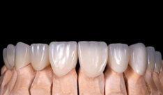 What Are Zirconium Crowns, and Why Are They So Popular?