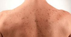 Are Sun Spots on the Skin Permanent