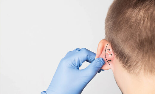 Otoplasty