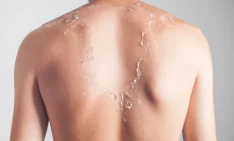 Peeling Skin After Sun Exposure