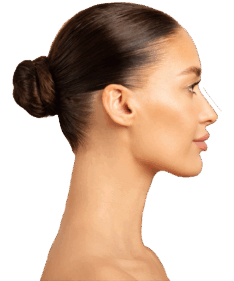 Rhinoplasty fillers