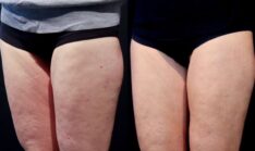 Summer-Friendly Solutions for Cellulite
