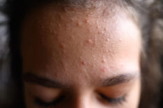 Why Do Acne and Blackheads Increase in Summer? 