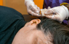 what-is-otoplasty-surgery