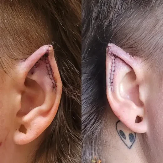How Protruding Ears and the Elf Ear Trend Are Redefining Beauty Standards 7 elf-ear-trends