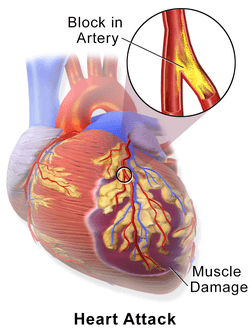 What Causes Heartache? How to Treat Heartache? 6 What Causes Heartache? How to Treat Heartache?
