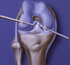 ACL Reconstruction