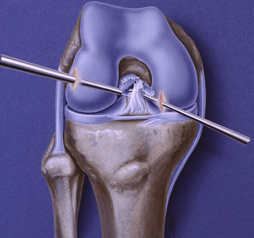 Why Athletes Trust ACL Reconstruction to Save Their Knees 6 ACL Reconstruction