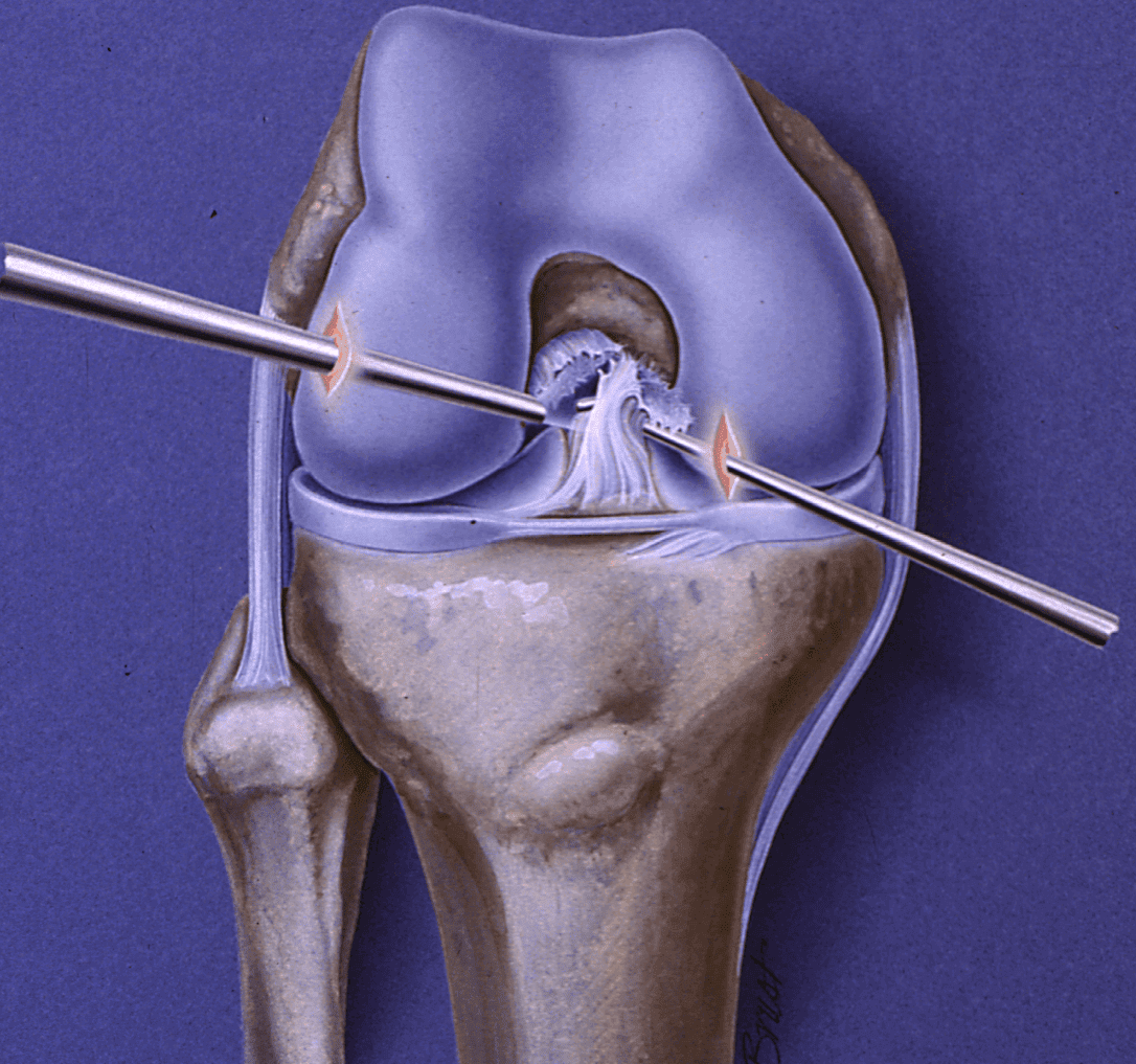 Why Athletes Trust ACL Reconstruction to Save Their Knees