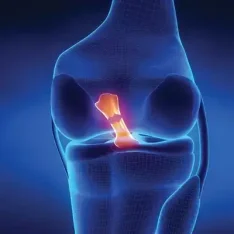 Athletes and Active Adults, When a Meniscus Tear Requires More Than Rest