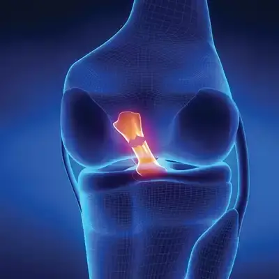 Athletes and Active Adults, When a Meniscus Tear Requires More Than Rest 6 Athletes and Active Adults, When a Meniscus Tear Requires More Than Rest
