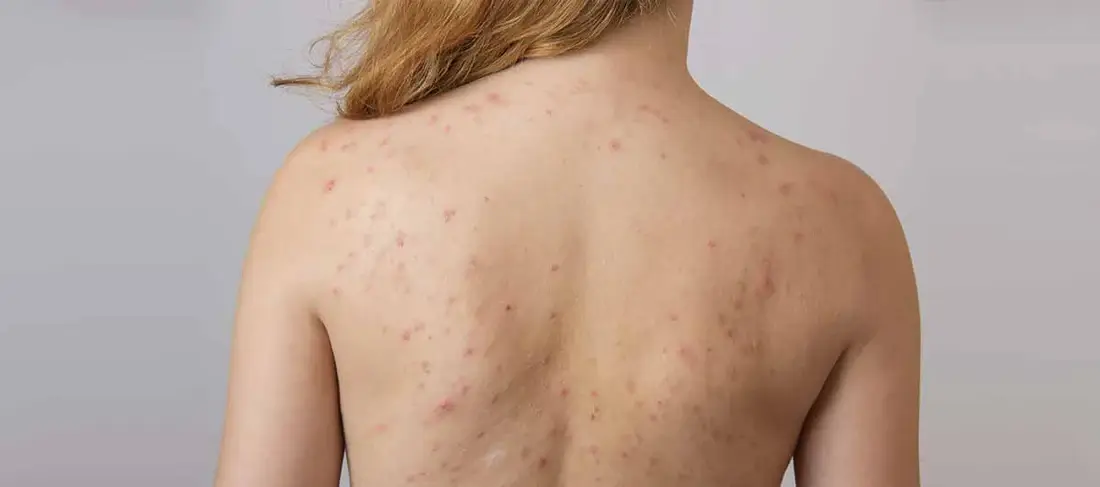 Back and Chest Acne After Sweating
