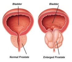 Benign Prostatic Hyperplasia (BPH)