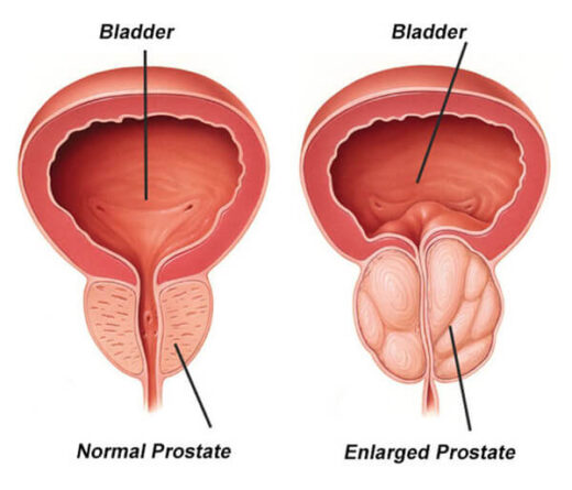 Benign Prostatic Hyperplasia (BPH) Treatment: A Comprehensive Guide 6 Benign Prostatic Hyperplasia (BPH) Treatment: A Comprehensive Guide