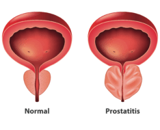 Does Prostate Discomfort Increase During Summer?