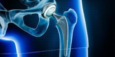 Hip Replacement