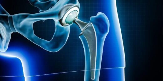 Is Hip Replacement the Right Move? 6 Hip Replacement