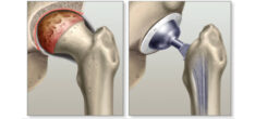 Hip Surgery