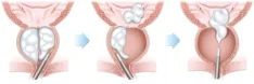 Holmium Laser Enucleation of the Prostate (HoLEP)