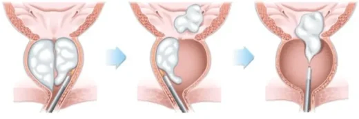 Holmium Laser Enucleation of the Prostate (HoLEP): A Comprehensive Overview 6 Holmium Laser Enucleation of the Prostate (HoLEP)
