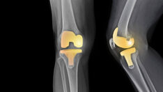 Knee Surgery
