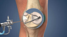 Meniscus Surgery