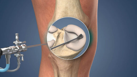 Why Meniscus Surgery Might Be Your Best Shot at Full Recovery 6 Why Meniscus Surgery Might Be Your Best Shot at Full Recovery