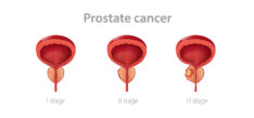 Prostate Cancer Surgery