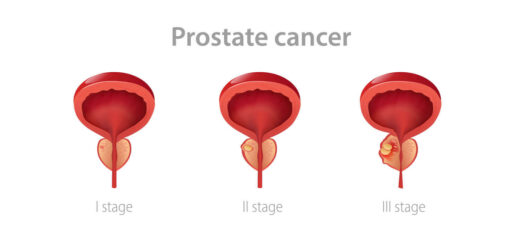 Prostate Cancer Surgery