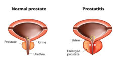 Prostatectomy