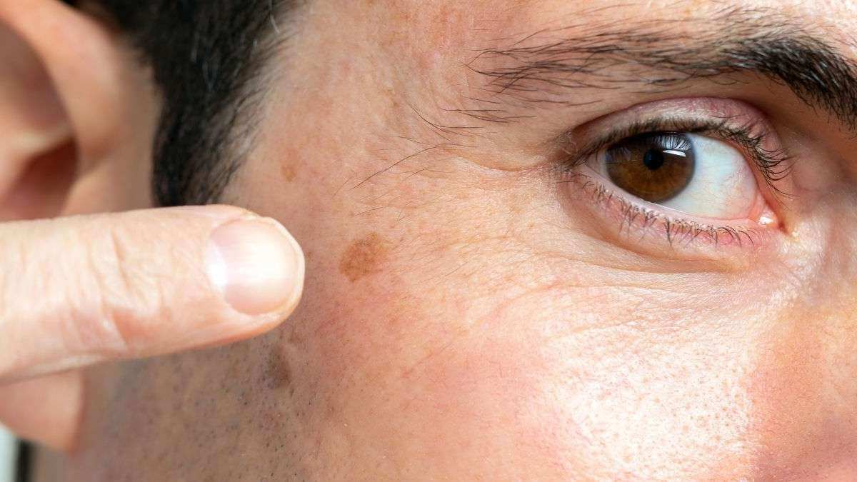 Sunspots in Men, Are They Permanent, Preventable, or a Warning Sign?