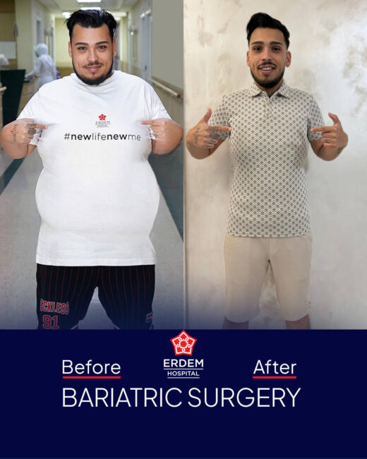 sleeve gastrique avant après